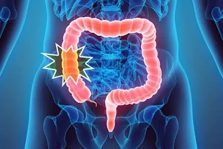 انتبه- 8 أعراض يسببها سرطان القولون في بدايته