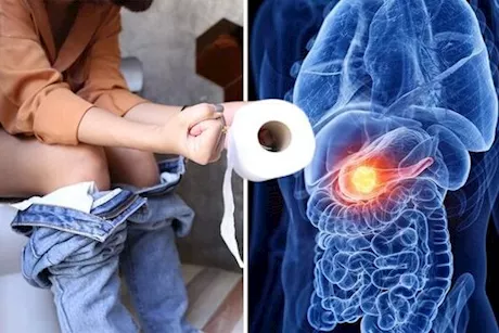 انتبه لبرازك- 4 أعراض لسرطان البنكرياس تظهر عليه