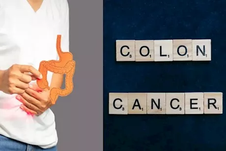 سرطان القولون في المرحلة الأخيرة- إليك أعراضه