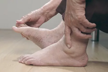 أفضل فيتامين للقدمين- 3 أنواع لعلاجهما من التورم