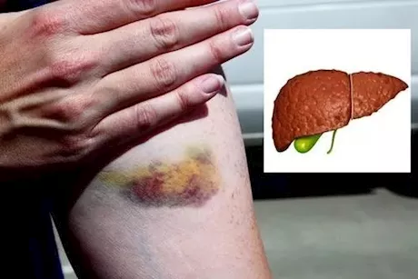 علامات مرض الكبد على الجلد- 6 أعراض تنذرك بتليفه