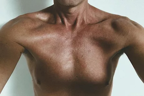 ما هي علامات سرطان الثدي لدى الرجال؟