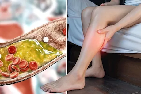 انتبه لساقيك- 6 أعراض ليلية لارتفاع الكوليسترول تظهر عليهما