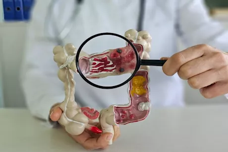 للوقاية من سرطان القولون- 5 أشياء لا تقربها