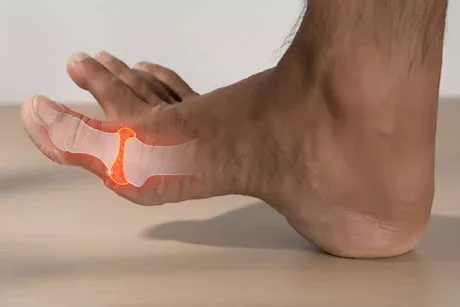 علاج ارتفاع حمض اليوريك طبيعيًا- 10 طرق قد تساعدك