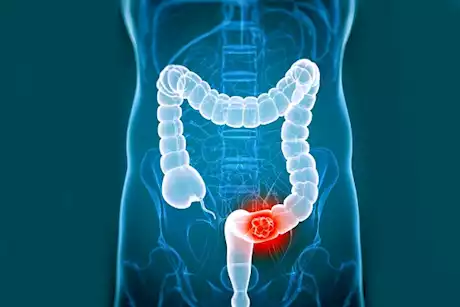 سرطان القولون والمستقيم يتزايد بين الشباب.. إليك أسبابه وأعراضه وطرق علاجه
