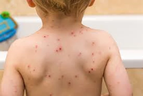طبيبة تحذر من الجدري المائي بين الأطفال_ هذه أعراضه