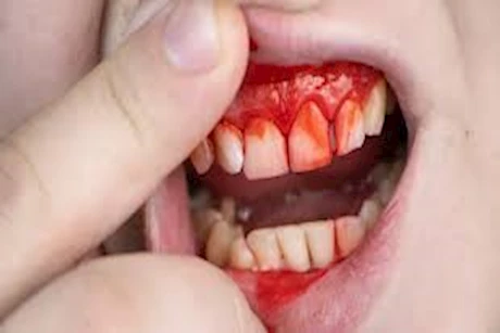 كيف يمكن لصحة الفم أن تشير إلى أمراض القلب والسكري؟
