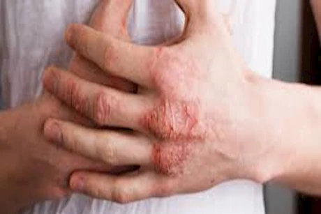 هل يساعد الكولاجين في علاج الأكزيما؟