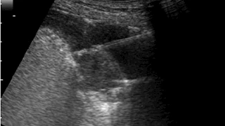 نجاح أول تشخيص للارتشاح البلوري بالسونار في مستشفى صدر المعمورة  