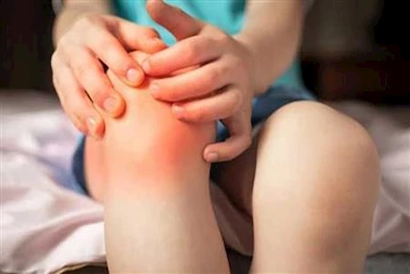 ما هى علامات التهاب المفاصل عند الأطفال؟