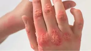 يجمد الجسد.. فيروس "غرب النيل" يصل بريطانيا لأول مرة