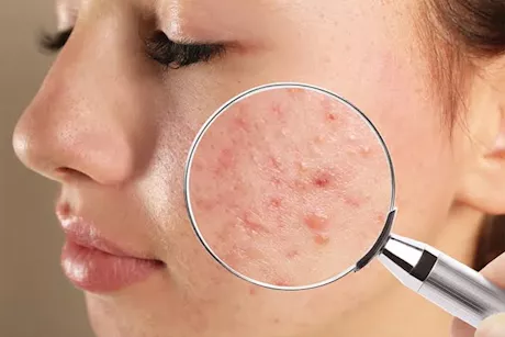  نقص أوميجا 3.. كيف يؤثر على البشرة؟