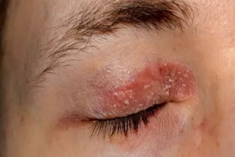 ما الذي يسبب الطفح الجلدي على الجفن؟