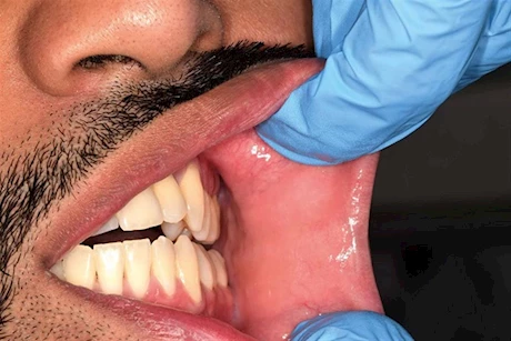 سرطان الفم لا يرتبط دائمًا بالتدخين- وهذه أسبابه وطرق الوقاية منه