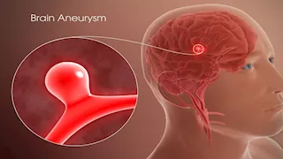 احذر.. أعراض محتملة لـ تمدد الأوعية الدموية