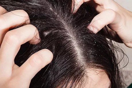 هل يمكن علاج فطريات الرأس بزيت شجرة الشاي؟