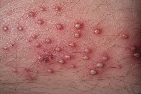 5 علاجات منزلية لالتهاب بصيلات الشعر في الجسم