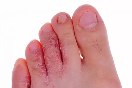 معجون الثوم لعلاج فطريات القدم- هل يحقق نتائج فعالة؟