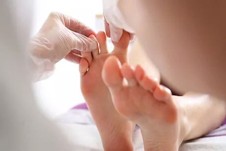 طرق طبيعية لعلاج سعفة القدم بالمنزل