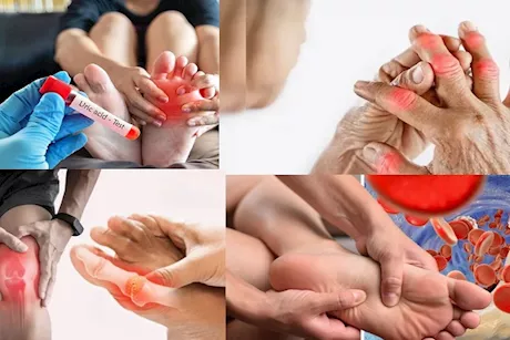تظهر على اليدين والقدمين- 4 أعراض لارتفاع حمض اليوريك احذرها