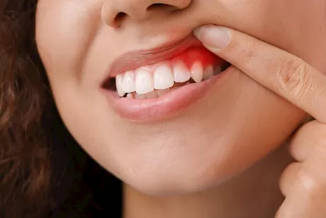 التهاب اللثة والدورة الشهرية.. إليك العلاقة بينهما