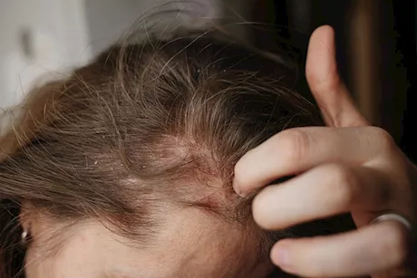 دماميل الرأس في الصيف.. هل يمكن علاجها بجل الصبار؟