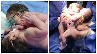 تفاصيل أول ولادة لتوأم ملتصق بالفيوم.. الأب يناشد وزير الصحة