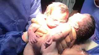 استجابة لـ"مصراوي".. مجلس الوزراء ينقل التوأم الملتصق للقاهرة للعلاج