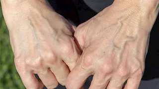 ظهور عروق اليد البارزة.. 5 حالات تستدعي الذهاب للطبيب
