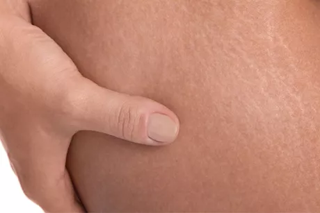 السمنة وصحة الجلد.. 7 حالات يجب الحذر منها