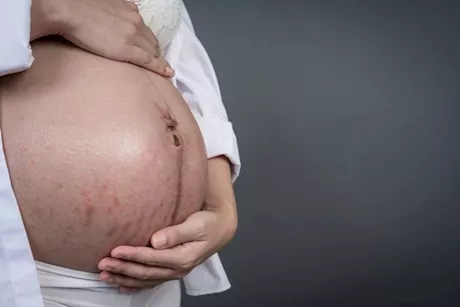 من حب الشباب إلى الكلف.. مشاكل البشرة الشائعة خلال فترات الحمل