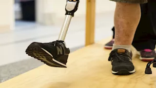 "رغم سلامتها".. لماذا يطلب البعض بتر أطرافهم؟