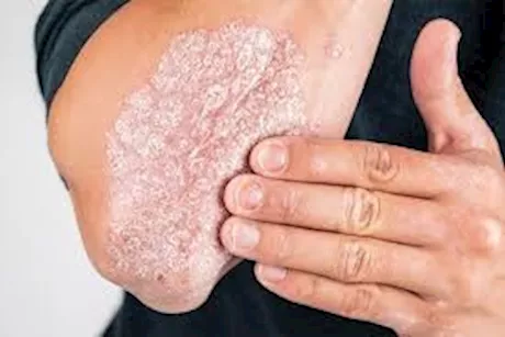 أبرزها التوتر- 5 أسباب شائعة لمرض الصدفية