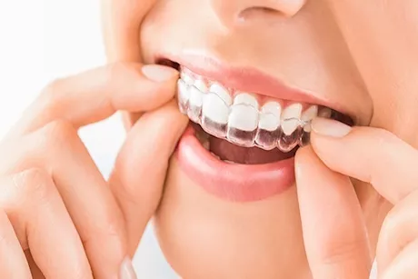 مميزات وعيوب التقويم الشفاف.. تعرف عليها