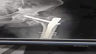 صحة المنيا تنقذ مُسنًا عمره 110 سنة بجراحة دقيقة.. ما القصة؟