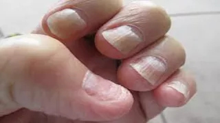 لا تلاحظها بسهولة.. 5 أعراض تدل على الإصابة بسرطان الأظافر 