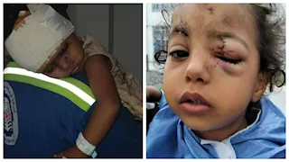 كارثة إنسانية.. كلاب ضالة تشوه وجه طفلة بالسويس (صور)