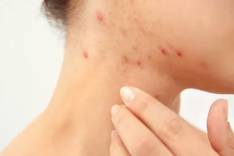 6 أسباب وراء ظهور حب الشباب في الرقبة