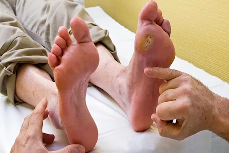 هل يمكن علاج قرحة القدم السكري بمستخلص السبانخ؟