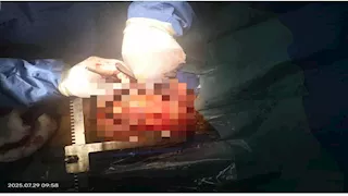 جراحة المستحيل.. كيف أعاد أطباء أسيوط النبض لصاحب القلب المقلوب؟ (صور)