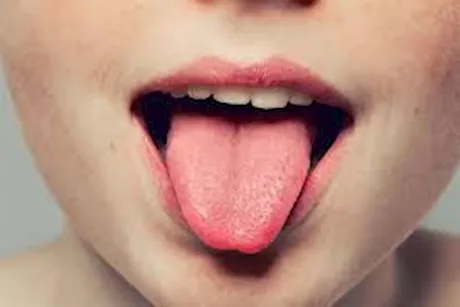 أسباب لسان الفراولة- هل له دلالات خطيرة؟