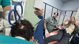 استخراج مقص من جمجمة مريض في جراحة دقيقة ببنها