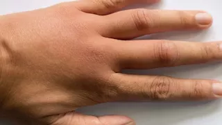 تظهر على أصابعك- 3 علامات تخبرك بأن كبدك مريض.. أعراض أمراض الكبد على الأصابع