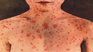 اليمن: 20 وفاة وأكثر من 7300 إصابة بالحصبة والكوليرا في تعز