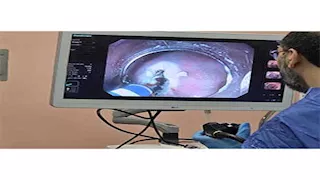 لأول مرة بالسويس.. "الرعاية الصحية" تعلن نجاح استخدام الذكاء الاصطناعي في مناظير القولون