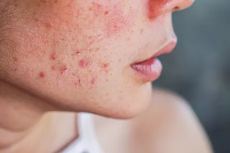  تظهر على البشرة- أعراض لنقص فيتامين د احذرها