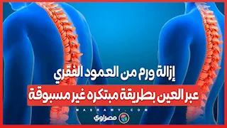 إزالة ورم من العمود الفقري عبر العين بطريقة مبتكره غير مسبوقة .. ماذا حدث؟