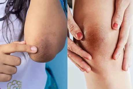 وداعًا لاسمرار الكوع والركبة- 8 وصفات لتبييضهما