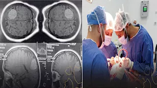 نجاح جراحتين دقيقتين لاستئصال ورم بالمخ وتثبيت فقرات عنقية بالسويس